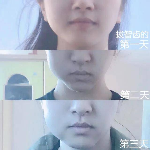 感受拔掉智齿后脸变小了,可能是拔牙后面颊的肿胀较显着,消肿后,给人