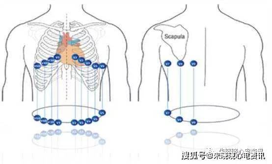 v1-v3导联心电图呈qs型时,一般需要记录下一肋间v1-v6导联心电图