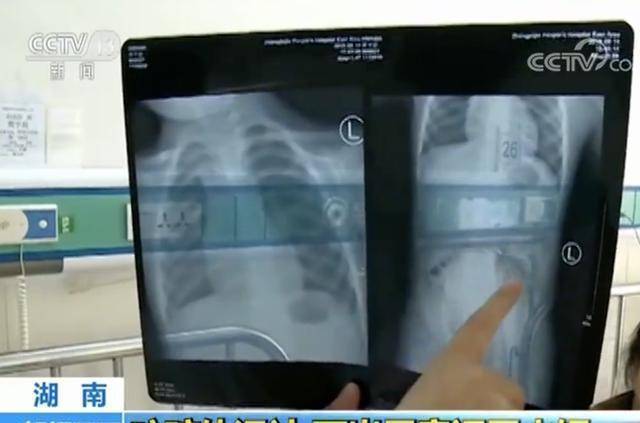 [体温计]吞下了水银，妈妈的明智做法值得点赞2岁娃咬碎体温计