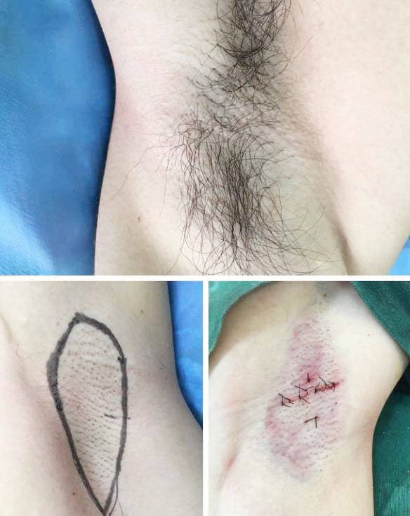 夏天可以做腋臭手术吗?贵阳很多朋友都在寻找治疗腋臭