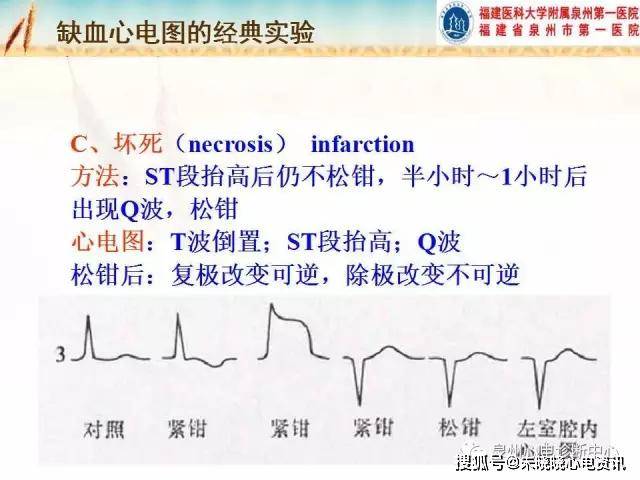 心肌缺血和心肌梗死的心电图改变ppt