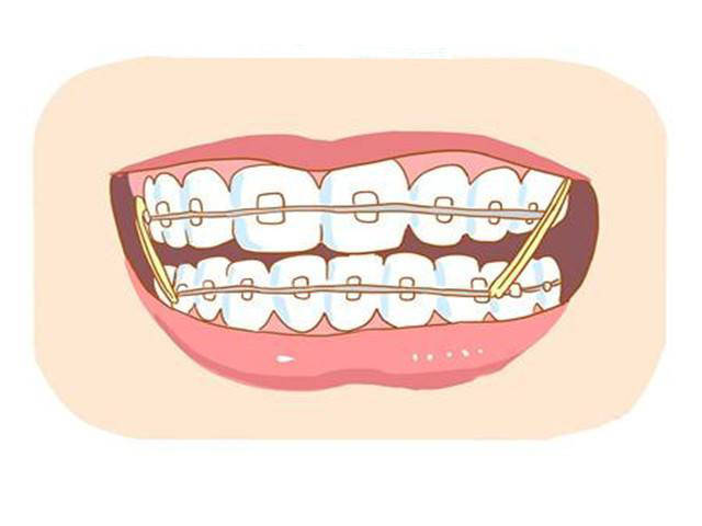 牙齿矫正为什么要那么久?能缩短吗?