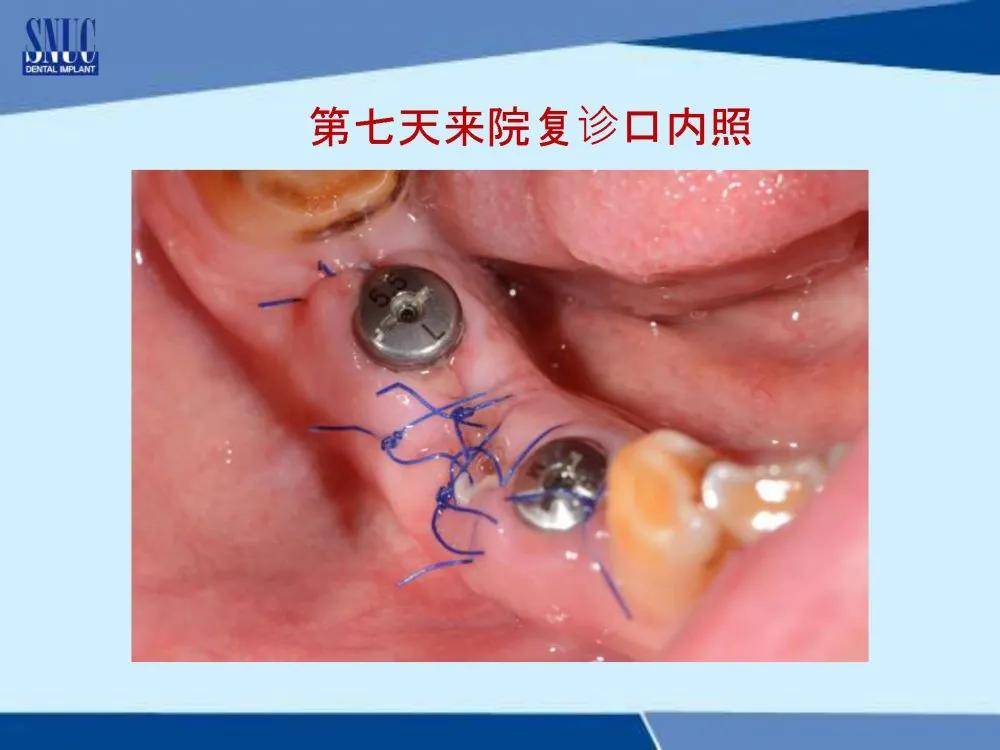 仕诺康 博益优速凝膜口腔病例