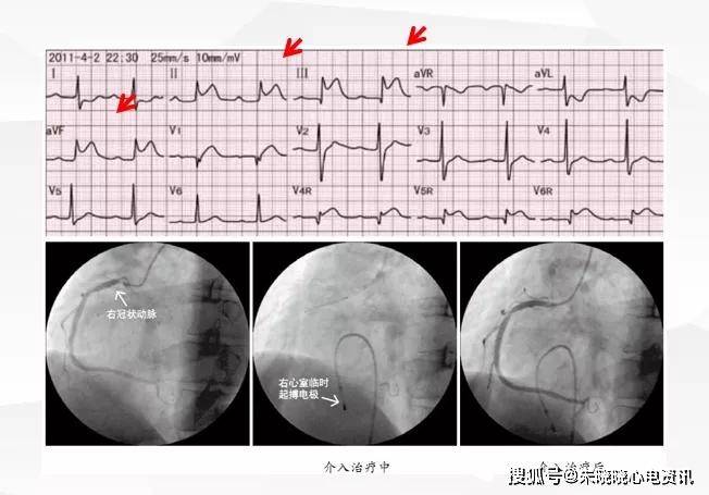 图文详解:急性心肌梗死的判读