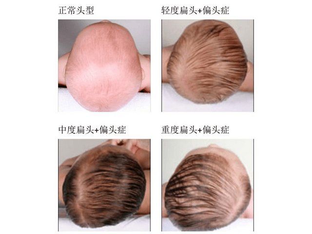 『孩子』宝妈别傻傻不知道婴儿该不该用枕头？如何用枕头有讲究