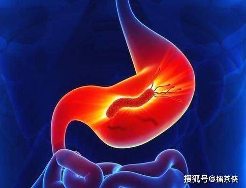 幽门螺杆菌忌吃什么食物 9b70c6c447fa4fe3ba133a0983f93b85.jpeg