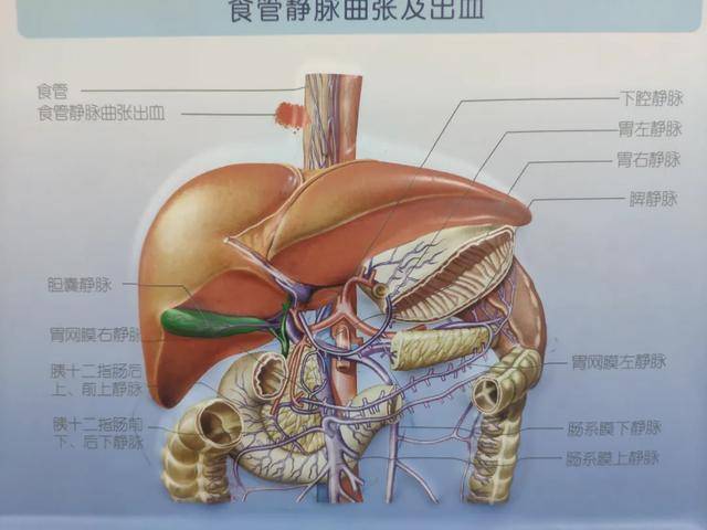 胆囊息肉转癌危及生命，纳米刀下获新生