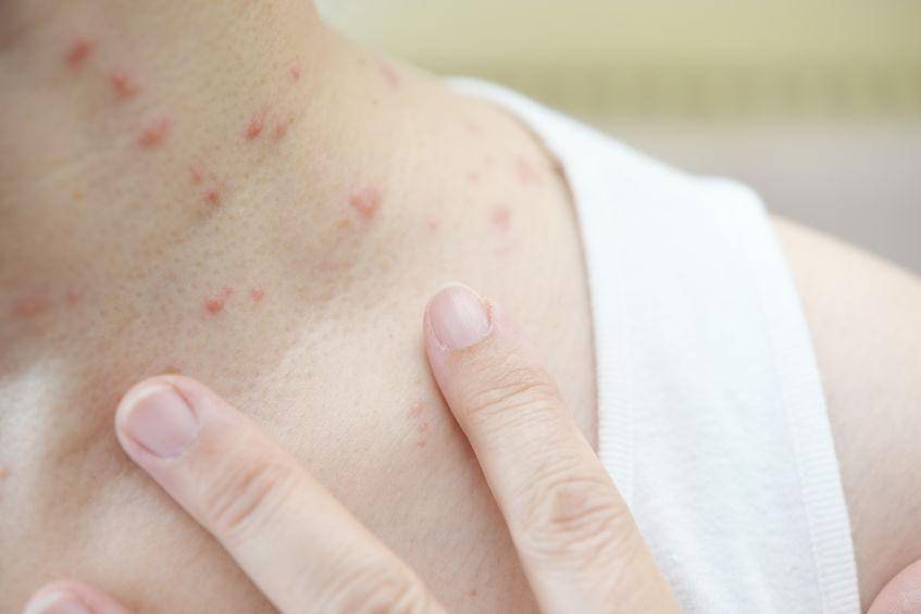 身上瘙痒是什么原因怎么办 f0c5bf71fbee4e749d21667eee819af9.jpeg