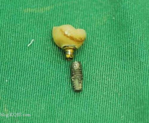 种牙最好的牌子排名 dbe07a374432405f9e5320f9c7641031.jpeg