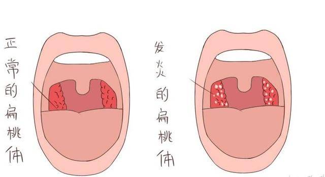 慢性扁桃体炎患者看过来,症状都有哪些?