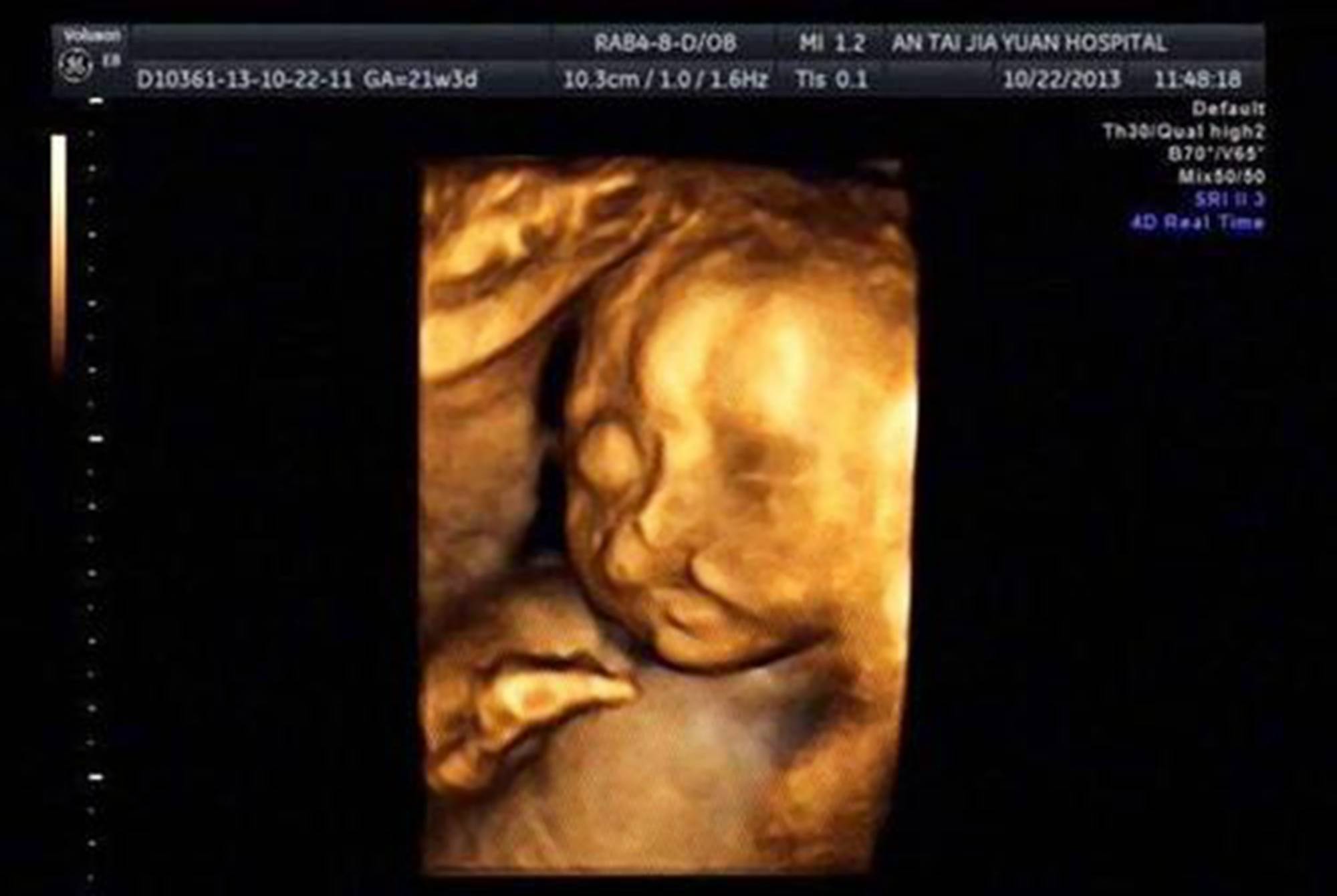 四维彩超时胎儿对着屏幕"吐泡泡,孕妈正高兴,医生却说不能留