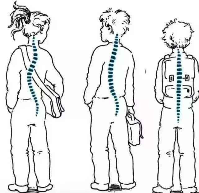 健康科普     对于脊柱侧弯较明显的青少年患者,可发现两侧肩胛有高低