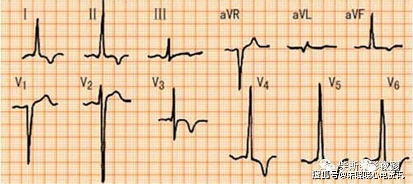 稳定型心绞痛和不稳定型心绞痛区别图表 840dda73e36c412e9ae0fd2fad5a1e4c.jpeg