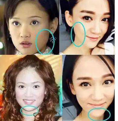 3咬肌咬肌都木有了,瘦脸针打打打~之前婴儿肥有点傻愣愣的,现在转变