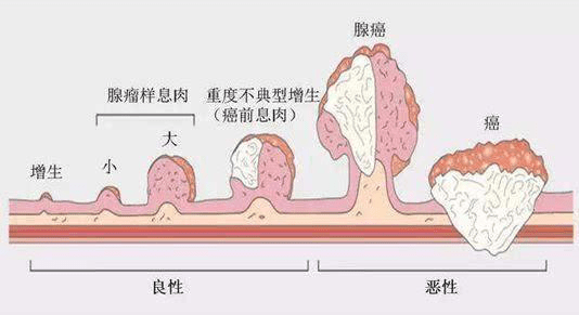 深圳市中医肛肠医院:息肉到癌的"一步之遥"(一)_手机