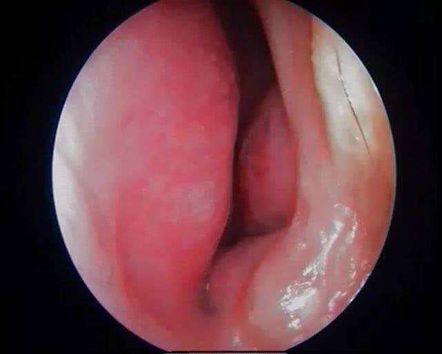 恐怖,鼻甲肥大时间长了居然会变成这样!清鼻堂提示你