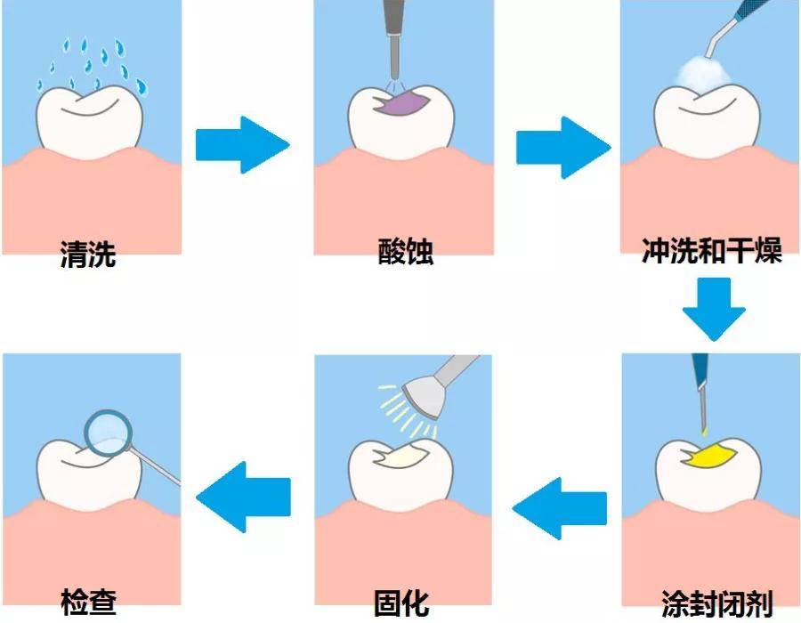 儿童龋齿率已超7成!除了涂氟,这件事应该尽早做-搜狐大视野-搜狐新闻