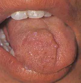 7,舌血管瘤