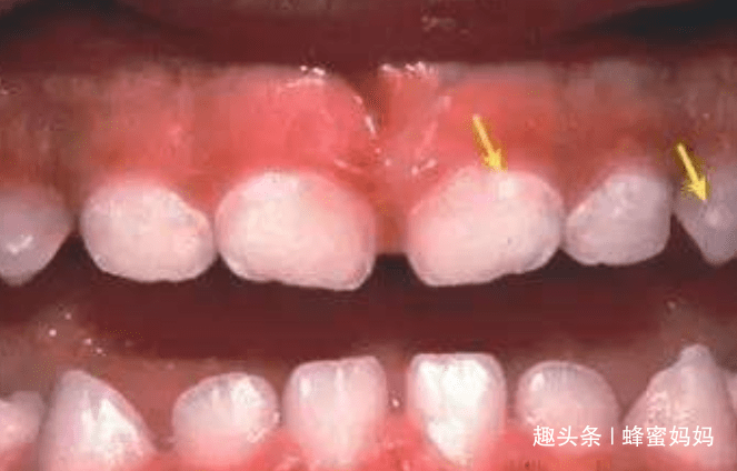 乳牙|重要时刻能“救命”？没这么简单宝宝“乳牙”掉了先别扔