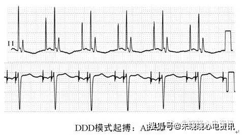 ①起搏时,每个心脏除极波(p波或qrs波)前均有一个脉冲钉信号; ②感知