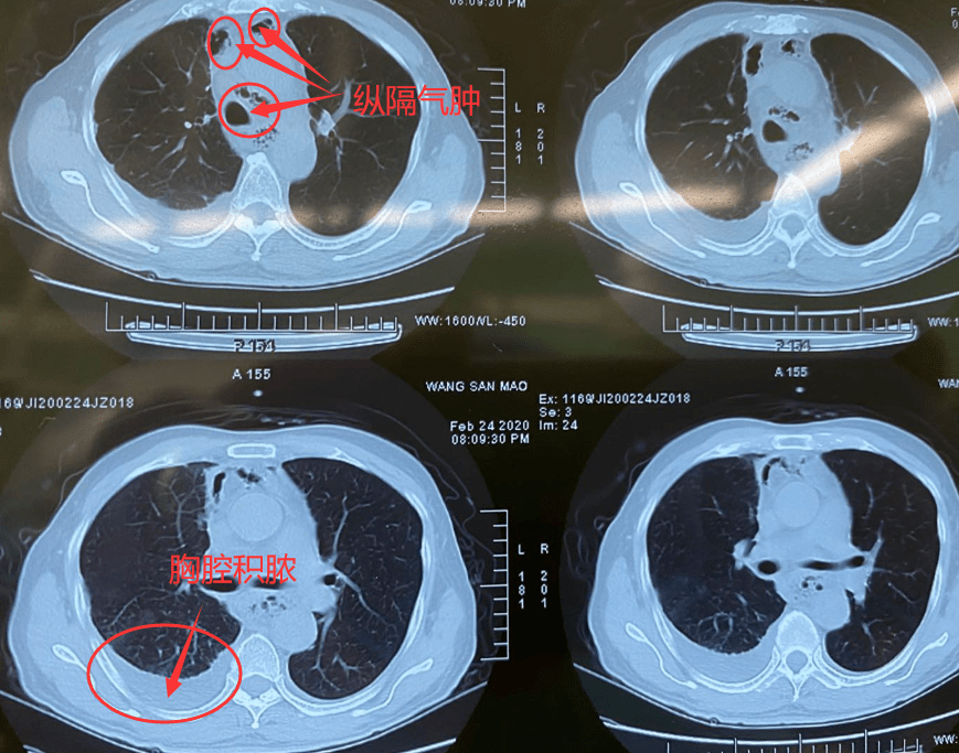 3进icu,4次病危,100天的生死营救,7旬企业家重拾健康!