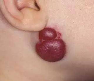 孩子各种胎记、血管瘤、斑、痣全面分析！