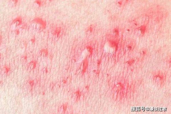 荨麻疹是一种自身免疫疾病,应该治疗的是自身免疫,不是它的症状