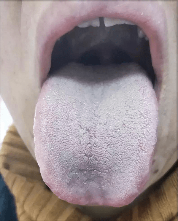 舌边有齿痕,舌前凹陷,舌苔白腻厚润 证型:脾虚湿阻型(脾胃虚弱,气血不