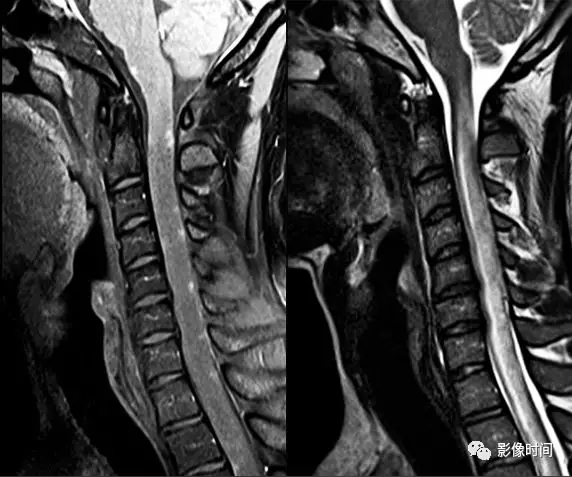 17种脊髓病变影像解读你get了吗