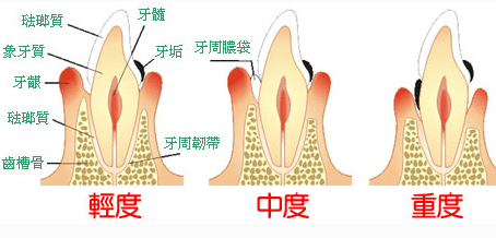 错误的刷牙法不正确的刷牙方法会破坏牙齿及牙周组织,如过硬的牙刷