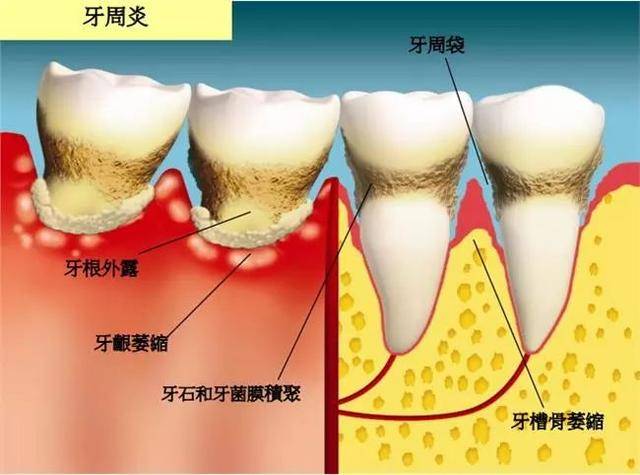 牙根并不是直接长在牙槽骨上的,牙根与牙槽骨之间隔着一层牙周膜,牙周