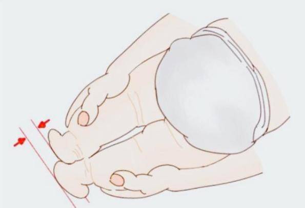宝宝腿纹不对称?这可不是闹着玩的!