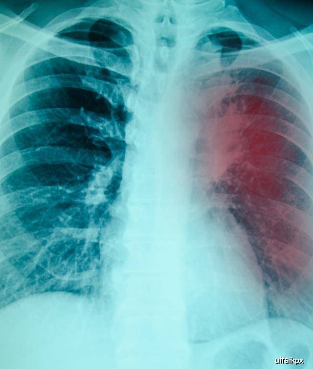 肺部ct能查出肺结核吗?出现3种情况就别拖了
