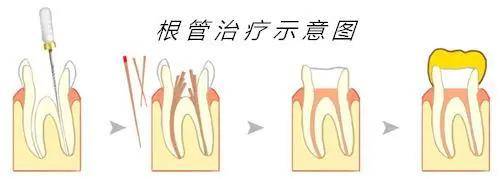 做完根管治疗的牙齿能用多长时间?
