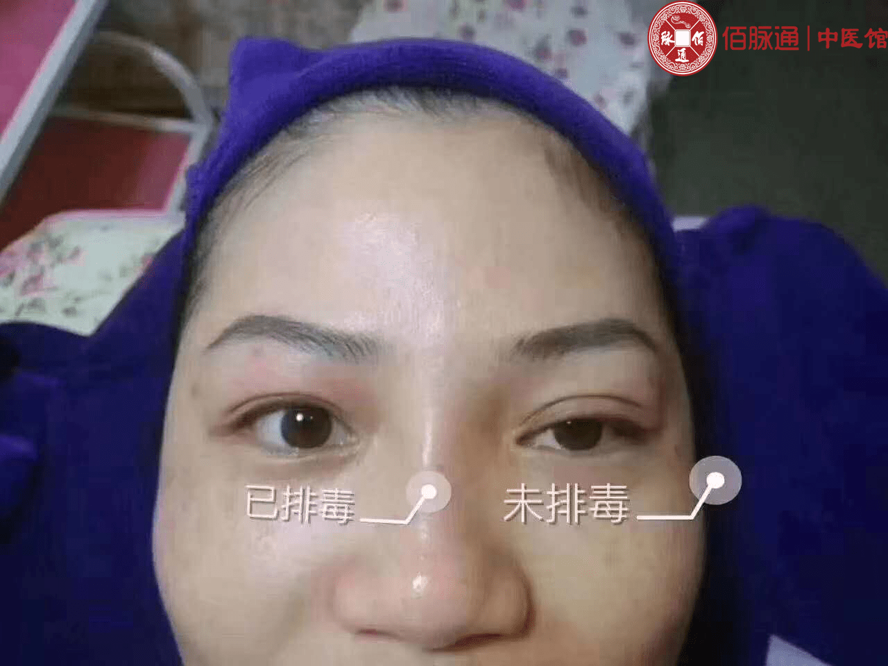 佰脉通中医馆眼部护理效果对比