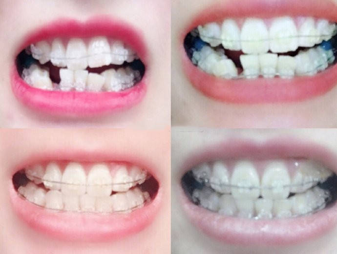 什么情况才需要拔牙 a13f1bc0fdd14bf9b34f6db9987f0dae.jpeg