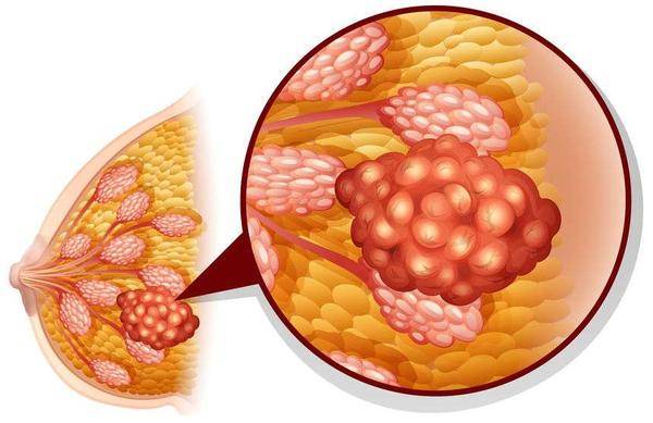 年龄|乳房下垂4个原因终于找到了！年龄排第四，排在第一很多女性都要经历