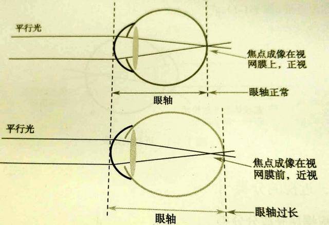 其中,屈光性近视:主要由于角膜或晶状体曲率过大或各屈光成分之间组合