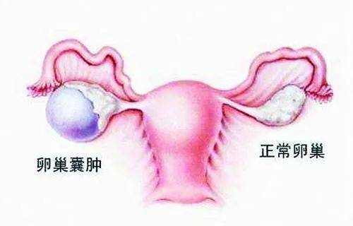 卵巢囊肿导致女性不孕的原因