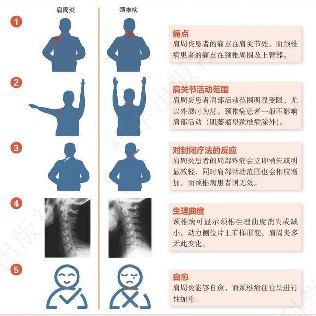 肩膀痛是到底是肩周炎还是颈椎病?