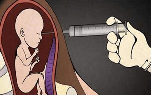 無痛流產，女性沒有任何感覺，對於胎兒來說卻異常殘忍。《網路文章》