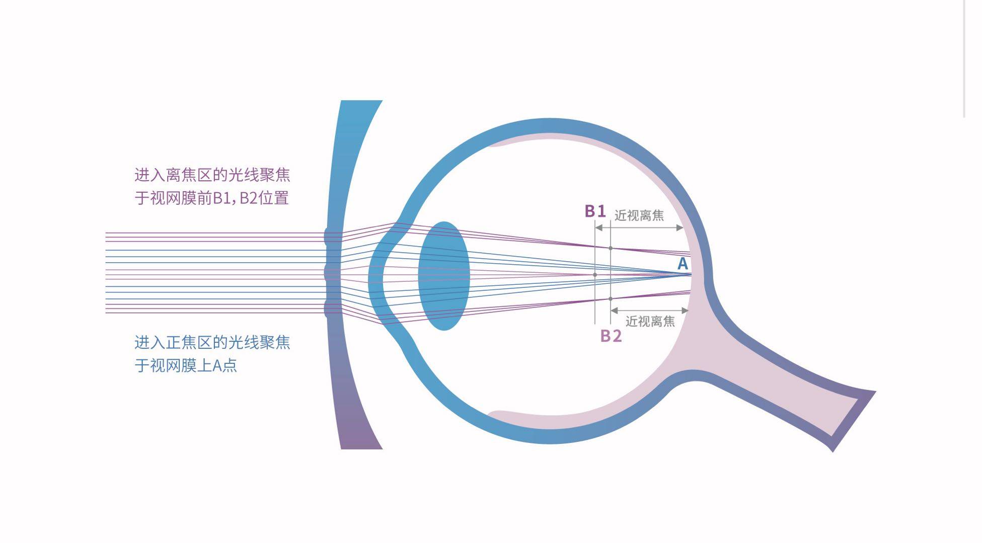 星优学ddm多点区域光学离焦技术助推近视防控