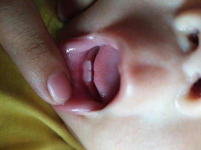 孩子|对照出牙时间和顺序，看看你家娃有没有达标？宝宝出牙前有症状