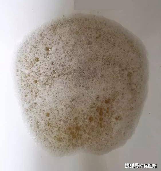 尿里有泡沫就是肾不好了？真相是？