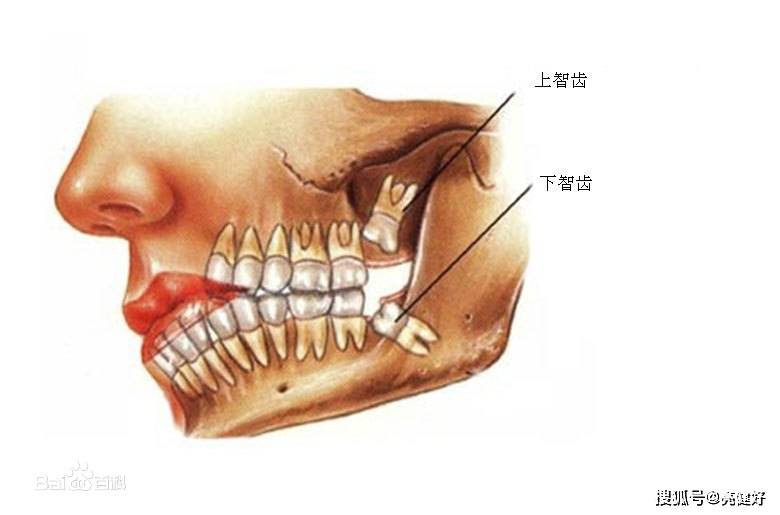 的症状往往是由于智齿的不完全萌出,牙冠部分包裹在牙龈周围形成盲袋