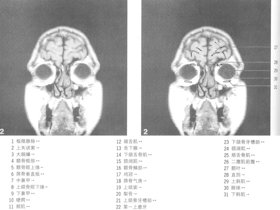 影像基础mri颅脑冠状位解剖图谱