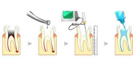 牙齿根管不通怎么办