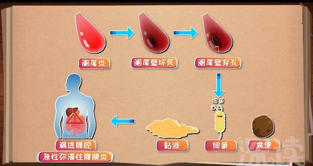 强势解读阑尾炎发病机制,燃