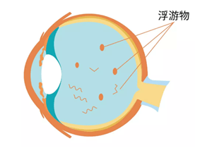 体在眼里面呈透明凝胶状,玻璃体脱水收缩,水与胶原分离形成玻璃体液化