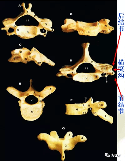 颈椎病解剖,经典影像改变,看这一篇就够了!